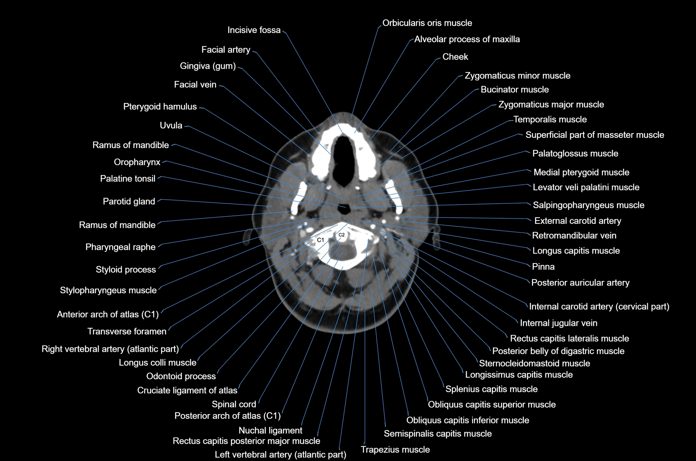 CT Neck axial cross sectional anatomy radiology image-img-00001-00023.webp